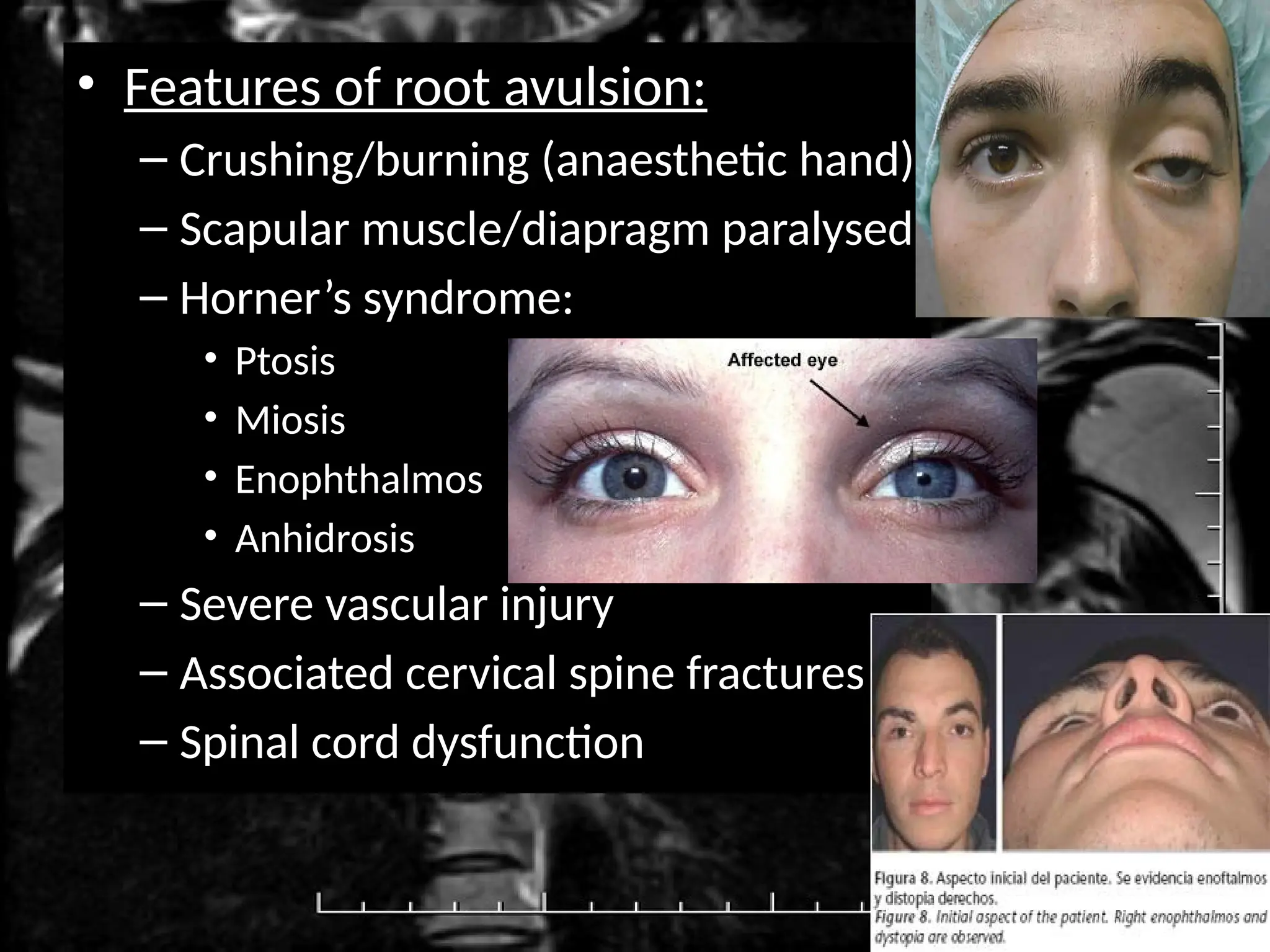 Brachial plexus and peripheral nerve injuryinjury.pptx