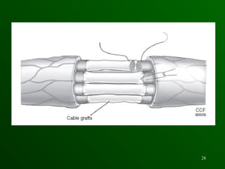 brachial plexus injury management ortho.ppt