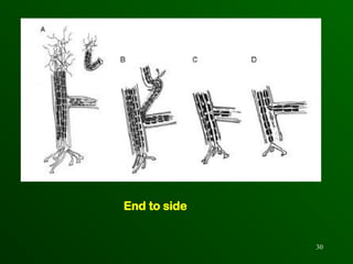 brachial plexus injury management ortho.ppt