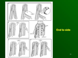 brachial plexus injury management ortho.ppt