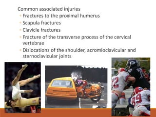 Common associated injuries
◦ Fractures to the proximal humerus
◦ Scapula fractures
◦ Clavicle fractures
◦ Fracture of the transverse process of the cervical
vertebrae
◦ Dislocations of the shoulder, acromioclavicular and
sternoclavicular joints
 
