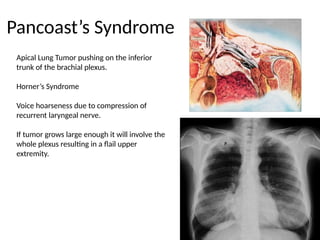 Brachial Plexus Lesions & Upper Extremity Nerves.pptx