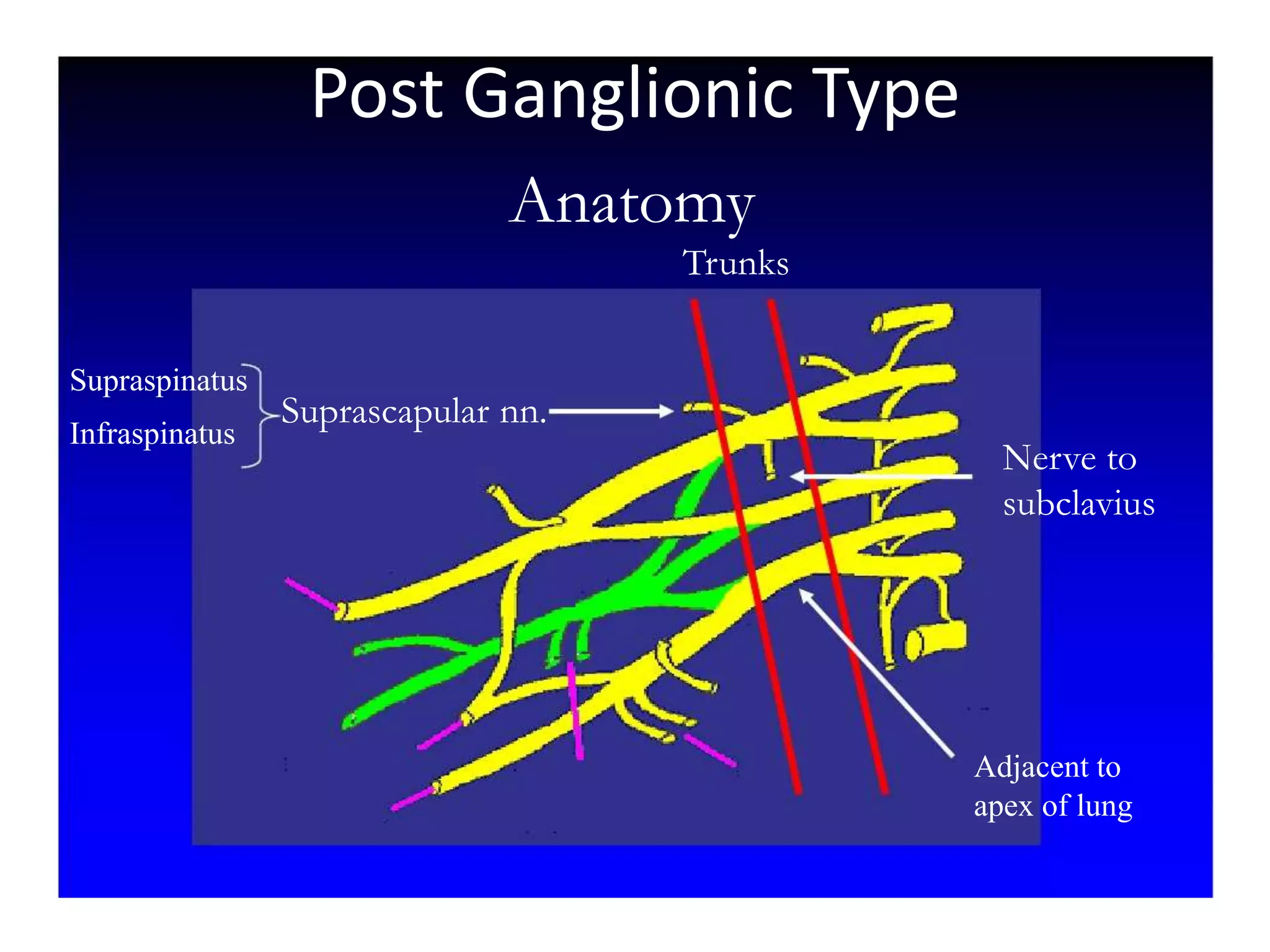 Anatomy
Trunks
Suprascapular nn.
Supraspinatus
Infraspinatus
Nerve to
subclavius
Adjacent to
apex of lung
Post Ganglionic Type
 
