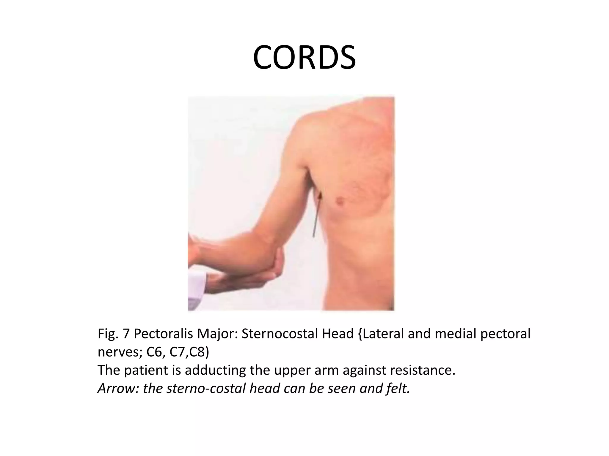 CORDS
Fig. 7 Pectoralis Major: Sternocostal Head {Lateral and medial pectoral
nerves; C6, C7,C8)
The patient is adducting the upper arm against resistance.
Arrow: the sterno-costal head can be seen and felt.
 