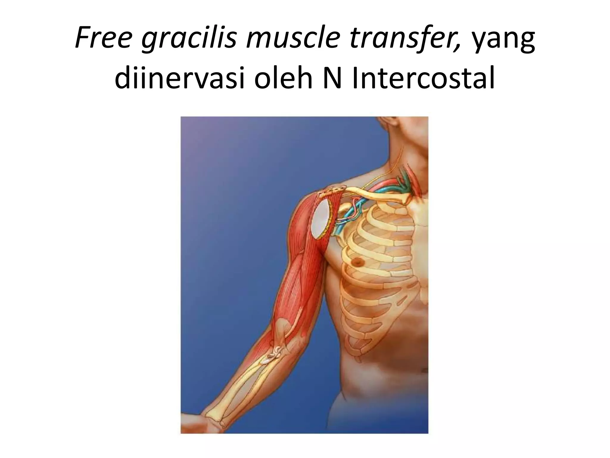 Free gracilis muscle transfer, yang
diinervasi oleh N Intercostal
 