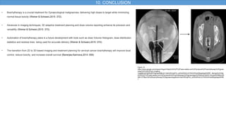 10. CONCLUSION
• Brachytherapy is a crucial treatment for Gynaecological malignancies, delivering high doses to target while minimizing
normal tissue toxicity (Weiner & Schwarz,2015 :372).
• Advances in imaging techniques, 3D adaptive treatment planning and dose-volume reporting enhance its precision and
versatility (Weiner & Schwarz,2015 :372).
• Automation of brachytherapy plans is a future development with tools such as dose Volume Histogram, dose distribution
statistics and isodose lines being used for accurate delivery (Weiner & Schwarz,2015 :372).
• The transition from 2D to 3D-based imaging and treatment planning for cervical cancer brachytherapy will improve local
control, reduce toxicity, and increase overall survival (Banerjee,Kamrava,2014 :559)
Figure 10:
https://www.google.com/imgres?imgurl=https%3A%2F%2Fwww.elekta.com%2Fproducts%2Fbrachytherapy%2Fgynec
ology%2Fimg%2Fgyn-imaging-
3.jpg&tbnid=gWKqIAPSgEqp2M&vet=12ahUKEwijrPzl_u2AAxW4sCcCHSAGAGwQMygQegQIARB1..i&imgrefurl=http
s%3A%2F%2Fwww.elekta.com%2Fproducts%2Fbrachytherapy%2Fgynecology%2F&docid=9sHE144udynKEM&w=60
0&h=375&q=3d%20brachytherapy%20gynaecology&ved=2ahUKEwijrPzl_u2AAxW4sCcCHSAGAGwQMygQegQIARB
1
 