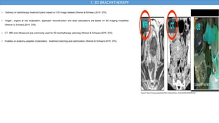 7. 3D BRACHYTHERAPY
• Delivery of radiotherapy treatment plans based on 3-D image dataset (Weiner & Schwarz,2015 :370).
• Target , organs at risk localization, applicator reconstruction and dose calculations are based on 3D imaging modalities
(Weiner & Schwarz,2015 :370).
• CT, MRI and Ultrasound are commonly used for 3D brachytherapy planning (Weiner & Schwarz,2015 :370).
• Enables an anatomy-adapted implantation, treatment planning and optimization (Weiner & Schwarz,2015 :370).
Figure 8 :https://inis.iaea.org/collection/NCLCollectionStore/_Public/49/093/49093363.pdf
 