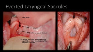 Everted Laryngeal Saccules
Dr. Hadi ALİHOSSEİNİ
 