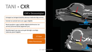 TANI - CXR
CXR’ın Dezavantajları
CT-Scan
Video-fluoroscopy
Faringeal ve laringeal daralma derecesi hakkında bilgi vermez.
Farenjit ve Larenjit tanısı için uygun değildir.
Nazal pasajların uygun şekilde değerlendirilmesine izin
vermez (anormal konka algılamak için)
Nazofarengeal çap veya yumuşak damağın uzunluğu
hakkında yeterli değildir.
Dr. Hadi ALİHOSSEİNİ
 