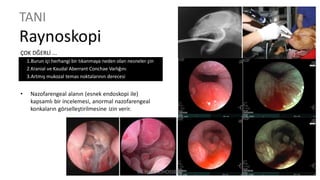 TANI
Raynoskopi
ÇOK DĞERLİ ...
1.Burun içi herhangi bir tıkanmaya neden olan nesneler çin
2.Kranial ve Kaudal Aberrant Conchae Varlığını
3.Artmış mukozal temas noktalarının derecesi
• Nazofarengeal alanın (esnek endoskopi ile)
kapsamlı bir incelemesi, anormal nazofarengeal
konkaların görselleştirilmesine izin verir.
Dr. Hadi ALİHOSSEİNİ
 