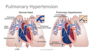 Pulmonary Hypertension
Dr. Hadi ALİHOSSEİNİ
 