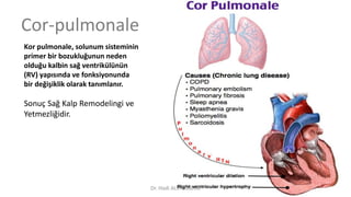 Cor-pulmonale
Kor pulmonale, solunum sisteminin
primer bir bozukluğunun neden
olduğu kalbin sağ ventrikülünün
(RV) yapısında ve fonksiyonunda
bir değişiklik olarak tanımlanır.
Sonuç Sağ Kalp Remodelingi ve
Yetmezliğidir.
Dr. Hadi ALİHOSSEİNİ
 