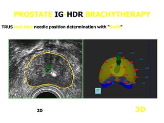 PROSTATE IG-HDR BRACHYTHERAPY
TRUS real-time needle position determination with “Swift”
2D 3D
 