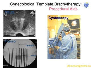 Gynecological Template Brachytherapy
Procedural Aids
TRUS
Cystoscopy
Tandem
seeds
Fluoro
jdemanes@cetmc.com
 