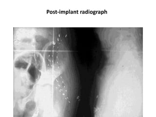Post-implant radiograph
 