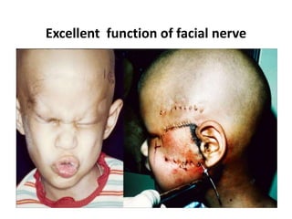 Excellent function of facial nerve
 