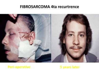 FIBROSARCOMA 4ta recurtrence
Peri-operative 5 years later
 