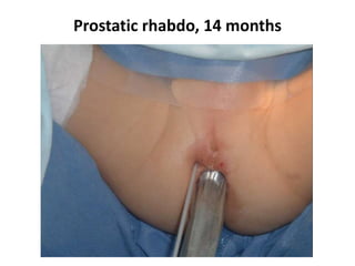 Prostatic rhabdo, 14 months
 