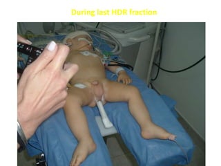 During last HDR fraction
 