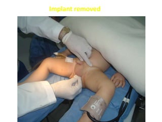 Implant removed
 