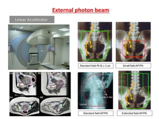 External photon beam
Standard field AP/PA
Standard field Rt & L:t Lat
Extended field AP/PA
Small field AP/PA
Linear Accelerator
 