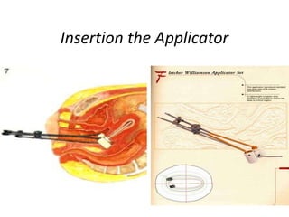 Insertion the Applicator
 