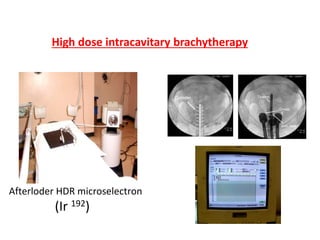 High dose intracavitary brachytherapy
Afterloder HDR microselectron
(Ir 192)
 