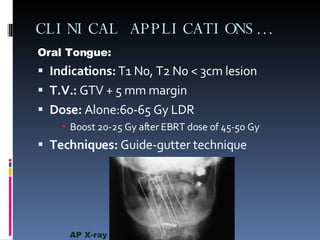 CLINICAL APPLICATIONS… Oral Tongue: Indications:  T1 N0, T2 N0 < 3cm lesion T.V.:  GTV + 5 mm margin Dose:  Alone:60-65 Gy LDR Boost 20-25 Gy after EBRT dose of 45-50 Gy Techniques:  Guide-gutter technique AP X-ray  