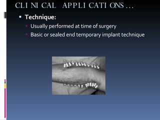 CLINICAL APPLICATIONS… Technique: Usually performed at time of surgery Basic or sealed end temporary implant technique 