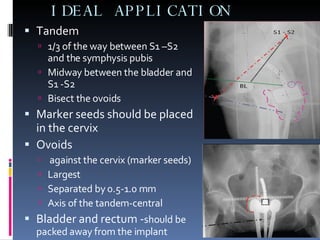 IDEAL APPLICATION Tandem  1/3 of the way between S1 –S2 and the symphysis pubis Midway between the bladder and S1 -S2 Bisect the ovoids Marker seeds should be placed in the cervix Ovoids  against the cervix (marker seeds) Largest  Separated by 0.5-1.0 mm Axis of the tandem-central Bladder and rectum - should be packed away from the implant 