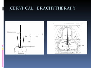 CERVICAL BRACHYTHERAPY 