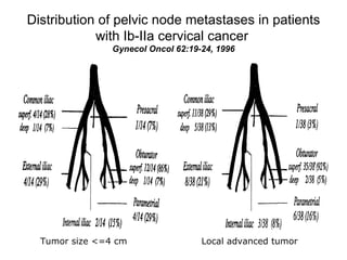 Distribution of pelvic node metastases in patients with Ib-IIa cervical cancer   Gynecol Oncol 62:19-24, 1996 Tumor size <=4 cm Local advanced tumor 