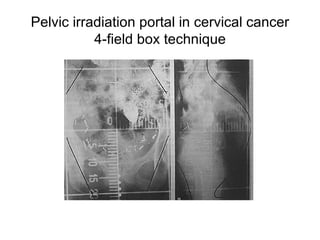 Pelvic irradiation portal in cervical cancer 4-field box technique 