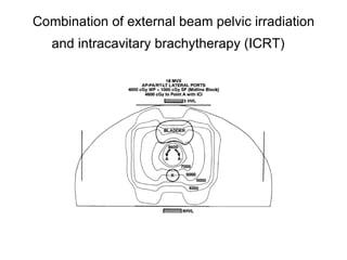 Combination of external beam pelvic irradiation and intracavitary brachytherapy (ICRT)   