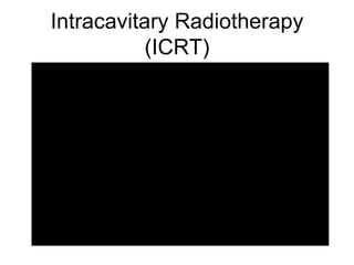 Intracavitary Radiotherapy (ICRT) 