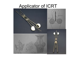 Applicator of ICRT 