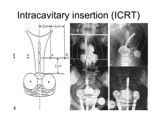 Intracavitary insertion (ICRT) 