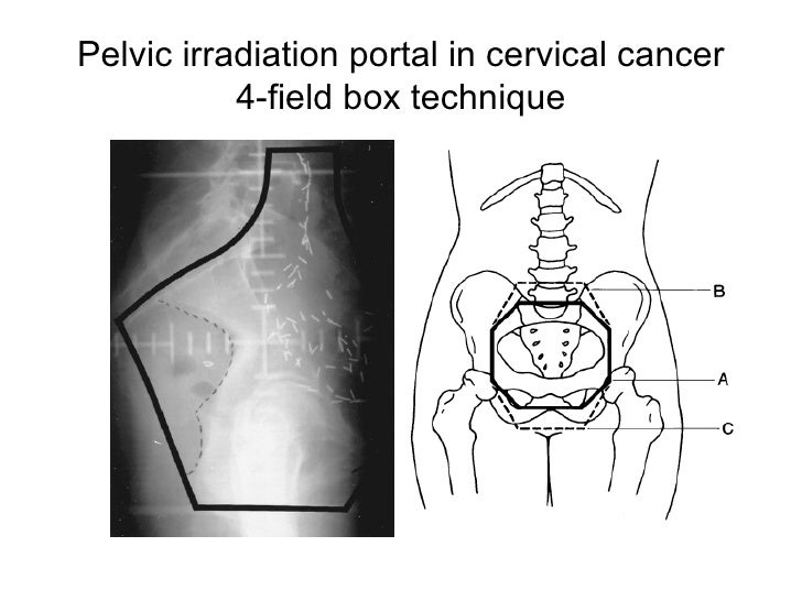 Brachytherapy And Gyn Malignancy