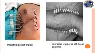 Interstitial Breast Implant Interstitial Implant in soft tissue
sarcoma
 