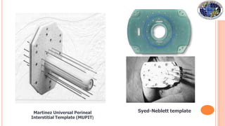 Martinez Universal Perineal
Interstitial Template (MUPIT)
Syed-Neblett template
 