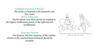 The lymphatic trapezoid: on the left on the AP radiograph,
and on the right on the lateral.
lymphatic trapezoid of fletcher
The points correspond to the paraaortic and
iliac nodes
Pelvic wall points
On the lateral view these points are marked as
the highest middistance points of the right and left
acetabulums.
Time dose fraction
the duration and time sequence of the implant
relative to the external beam treatment should be
recorded.
 