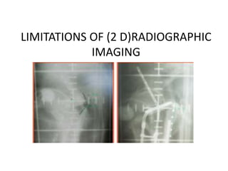 LIMITATIONS OF (2 D)RADIOGRAPHIC
IMAGING
 