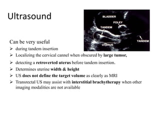 Ultrasound
Can be very useful
 during tandem insertion
 Localizing the cervical cannel when obscured by large tumor,
 detecting a retroverted uterus before tandem insertion.
 Determines uterine width & height
 US does not define the target volume as clearly as MRI
 Transrectal US may assist with interstitial brachytherapy when other
imaging modalities are not available
 