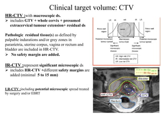 Clinical target volume: CTV
,
HR-CTV :with macroscopic ds.
 includes GTV + whole cervix + presumed
extracervical tumour extension+ residual ds
Pathologic residual tissue(s) as defined by
palpable indurations and/or grey zones in
parametria, uterine corpus, vagina or rectum and
bladder are included in HR-CTV.
 No safety margin are added.
IR-CTV :represent significant microscopic ds
 includes HR-CTV +different safety margins are
added (minimal 5 to 15 mm)
LR-CTV :including potential microscopic spread treated
by surgery and/or EBRT
 
