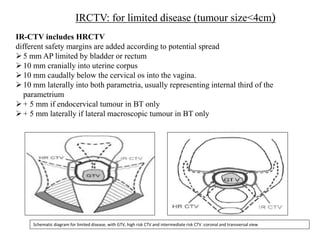IR-CTV includes HRCTV
different safety margins are added according to potential spread
5 mm AP limited by bladder or rectum
10 mm cranially into uterine corpus
10 mm caudally below the cervical os into the vagina.
10 mm laterally into both parametria, usually representing internal third of the
parametrium
+ 5 mm if endocervical tumour in BT only
+ 5 mm laterally if lateral macroscopic tumour in BT only
IRCTV: for limited disease (tumour size<4cm)
Schematic diagram for limited disease, with GTV, high risk CTV and intermediate risk CTV :coronal and transversal view
 