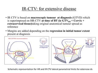 IR-CTV: for extensive disease
• IR CTV is based on macroscopic tumour at diagnosis (GTVD) which
is superimposed on HR-CTV at time of BT (ie GTVBT + Cervix +
extracervical tissue)taking original anatomical tumour spread as
reference
• Margins are added depending on the regression in initial tumor extent
present at diagnosis
Schematic representation for HR and IR CTV lateral parametrial limits for extensive ds
 