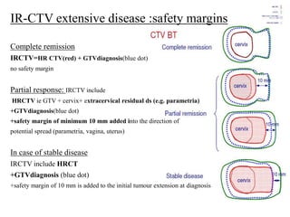 IR-CTV extensive disease :safety margins
Complete remission
IRCTV=HR CTV(red) + GTVdiagnosis(blue dot)
no safety margin
Partial response: IRCTV include
HRCTV ie GTV + cervix+ extracervical residual ds (e.g. parametria)
+GTVdiagnosis(blue dot)
+safety margin of minimum 10 mm added into the direction of
potential spread (parametria, vagina, uterus)
In case of stable disease
IRCTV include HRCT
+GTVdiagnosis (blue dot)
+safety margin of 10 mm is added to the initial tumour extension at diagnosis
 
