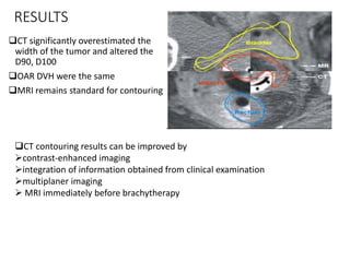 RESULTS
CT significantly overestimated the
width of the tumor and altered the
D90, D100
OAR DVH were the same
MRI remains standard for contouring
CT contouring results can be improved by
contrast-enhanced imaging
integration of information obtained from clinical examination
multiplaner imaging
 MRI immediately before brachytherapy
 