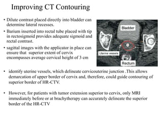 Improving CT Contouring
• Dilute contrast placed directly into bladder can
determine lateral recesses.
• Barium inserted into rectal tube placed with tip
in rectosigmoid provides adequate sigmoid and
rectal contrast.
• sagittal images with the applicator in place can
ensure that superior extent of cervix
encompasses average cervical height of 3 cm
• identify uterine vessels, which delineate cervicouterine junction .This allows
demarcation of upper border of cervix and, therefore, could guide contouring of
superior border of HR-CTV.
• However, for patients with tumor extension superior to cervix, only MRI
immediately before or at brachytherapy can accurately delineate the superior
border of the HR-CTV
 