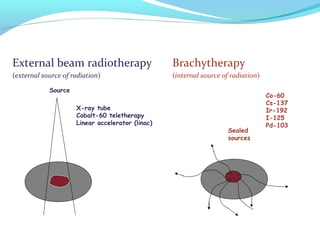 External beam radiotherapy Brachytherapy
(external source of radiation) (internal source of radiation)
Source
Sealed
sources
X-ray tube
Cobalt-60 teletherapy
Linear accelerator (linac)
Co-60
Cs-137
Ir-192
I-125
Pd-103
 